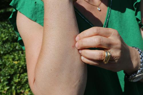 Les Aubois Victimes De Piqures D Insectes Non Identifies