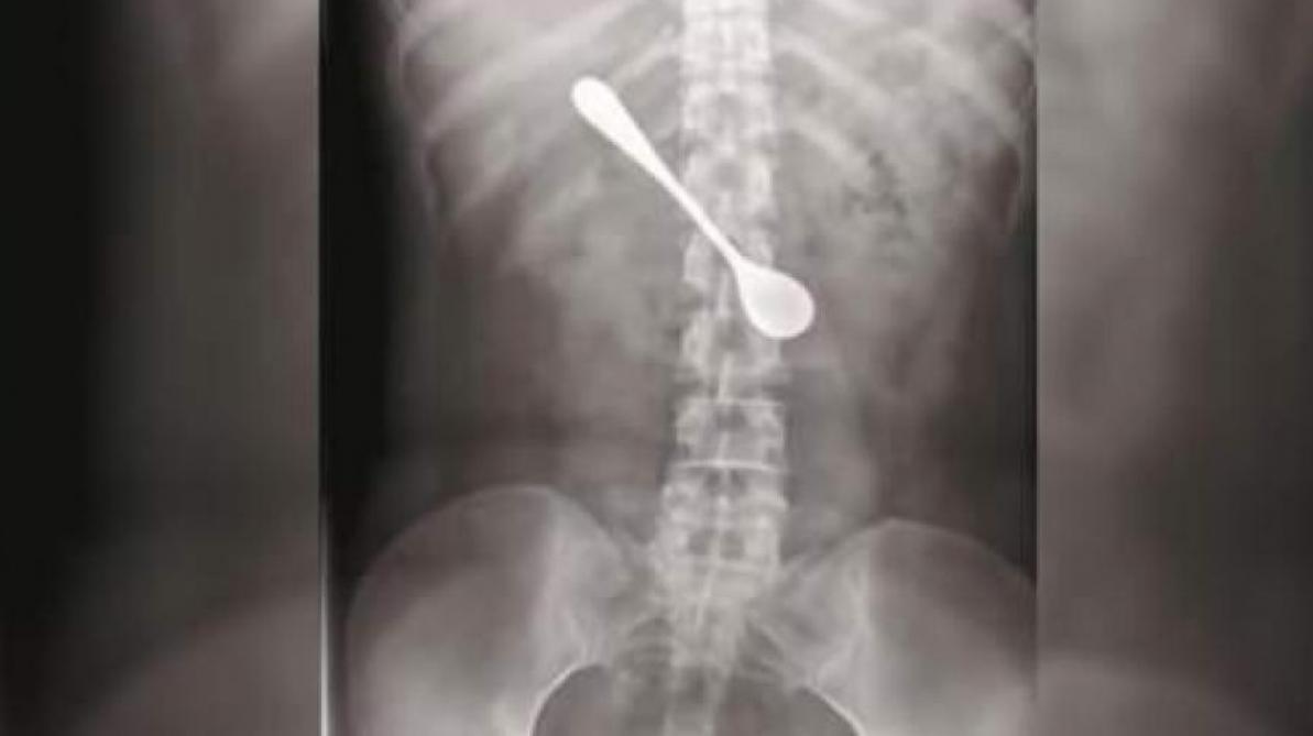 Arête De Poisson Coincée Dans L Oesophage