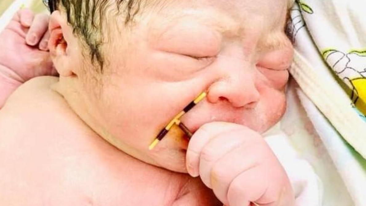 Photo Virale Un Bebe Nait Avec Le Sterilet De Sa Mere Dans La Main