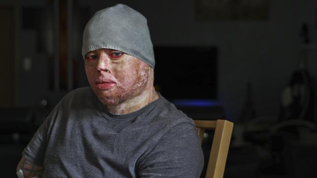 Olivier Ferrand, 38 ans, a subi entre 40 et 50 opérations chirurgicales depuis son accident qui lui a brûlé 97% de sa peau quand il avait 9 ans.