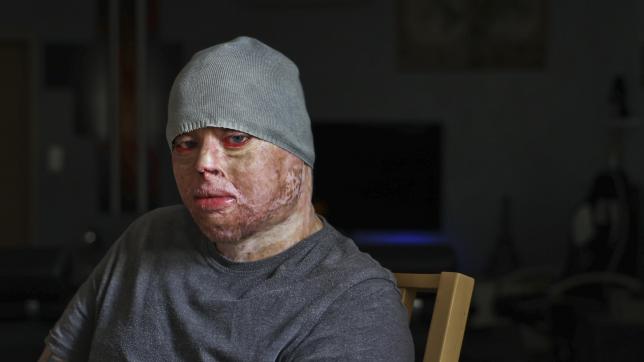 Olivier Ferrand, 38 ans, a subi entre 40 et 50 opérations chirurgicales depuis son accident qui lui a brûlé 97% de sa peau quand il avait 9 ans.